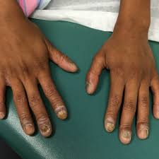 nail dystrophy and nail plate thinning