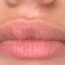 fix scar tissue in the lip