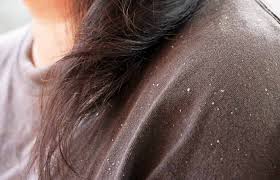 wet dandruff what is it and how to