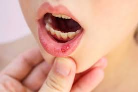 children with mouth sores heal