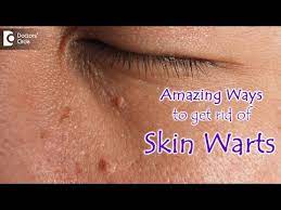skin warts skin wart removal