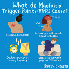 myofascial trigger point what they