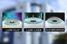 eyes before and after lasik treatment