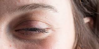 droopy eyelids causes treatment for