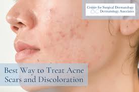 treat acne scars and discoloration