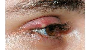 infected eye 8 common causes