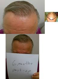 28 Albums Of Hair Transplant Growth Chart Explore