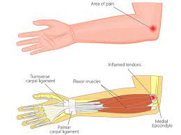 elbows and golfers elbow exercises