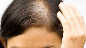 hair loss due to pcos causes