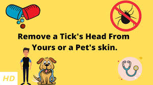 remove a tick s head from yours or a