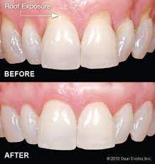 gum grafting nkc dental
