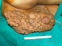 giant gluteal lipoma like liposarcoma