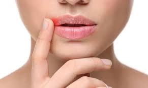5 common canker sore triggers to avoid