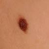 In more advanced melanoma, the texture of the spot may change. 1