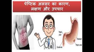 peptic ulcer treatment and ayurveda