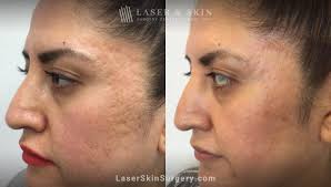 acne scars treatment in new york laser ny