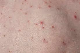 bacterial skin rash 9 common infections