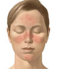 controlling the redness of rosacea