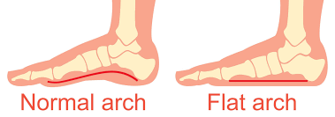how flat feet can cause foot pain while