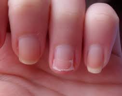 split nail causes remes
