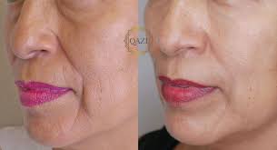 treatment for wrinkles and sagging jowls