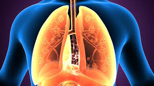 Asthma affects millions of people. Eosinophilic Asthma Symptoms Diagnosis And Treatment