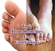 remes for foot fungus