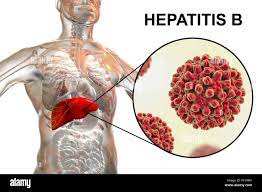 Hepatitis-B-Infektion. Computer ...
