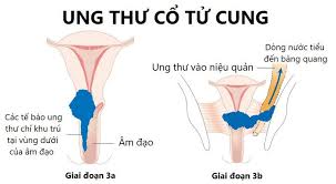 symptoms of se 3 cervical cancer and