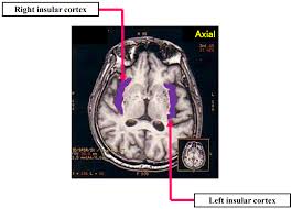 neuroanatomy of takotsubo syndrome