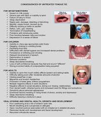 tongue tie and lip tie in infants