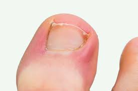 ingrowing toenails onychocryptosis