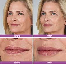 lip augmentation lazeo