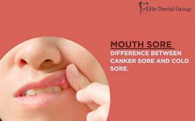 mouth sores canker and cold sores