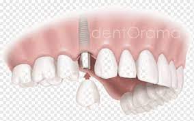 Dental implant Dentistry Edentulism Tooth, bridge, dentistry, bridge, lip  png | PNGWing