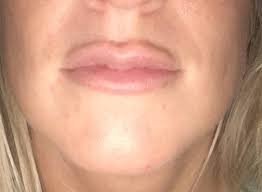 unhappy with lip injections want to