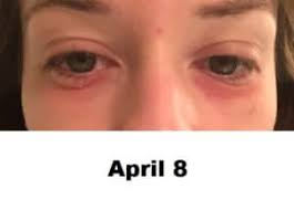 the mysterious eye rash allergy
