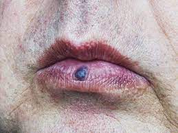 swollen upper lip causes and treatments