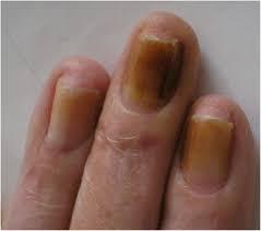 yellow nail syndrome