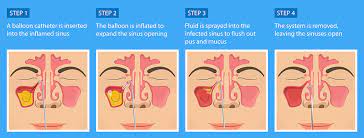 10 signs you have a sinus infection
