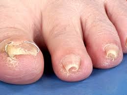 pincer nail pincet nagel buis nagel