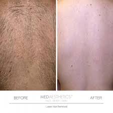 If it is overdone, it can reactivate hair follicles. Medical Laser Hair Removal Perth Skin Laser Clinic