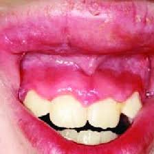 chronic swelling of the upper lip
