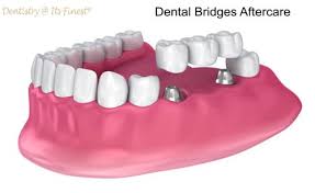 dental bridges recovery and aftercare