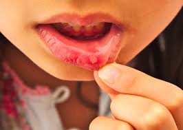 should you try to pop a canker sore