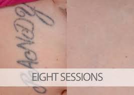 Most tattoos will require between five and ten sessions. How Much Will My Laser Tattoo Removal Cost Eraditatt