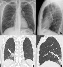 Radiographic And Chest Ct Imaging