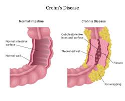 understanding crohn s disease a risk