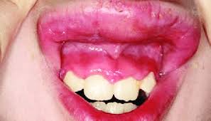 chronic swelling of the upper lip