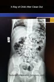 X Ray After Clean Out X Ray Constipated Child Bristol Stool